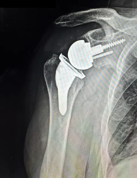 X-ray of a reverse shoulder replacement
