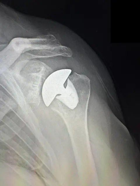 X-ray of a total shoulder replacement