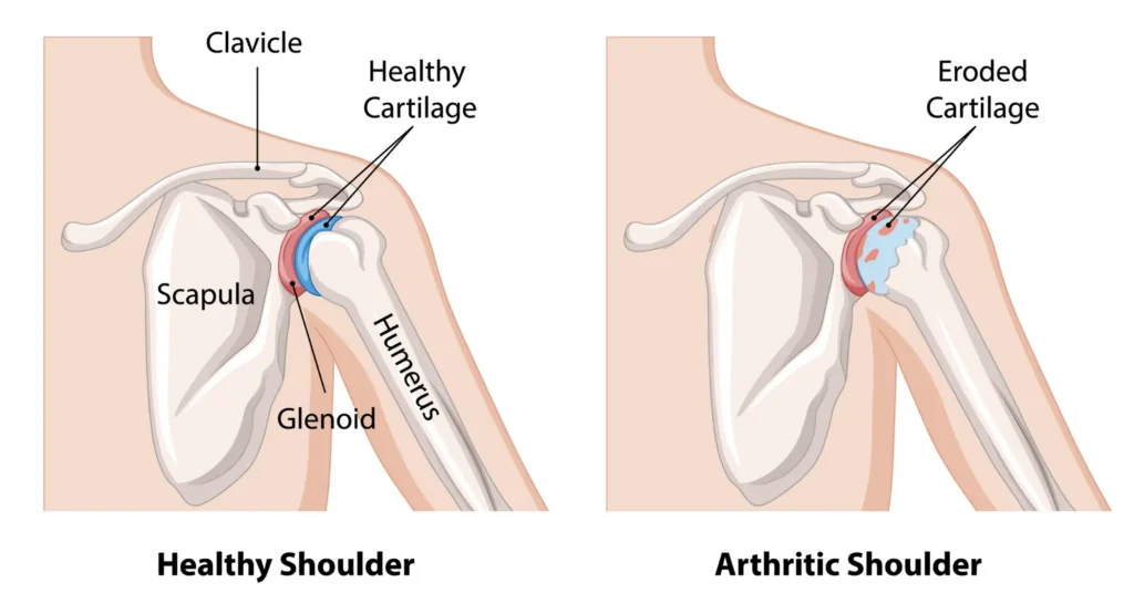shoulder arthritis diagram, comparing a healthy and arthritic shoulder.