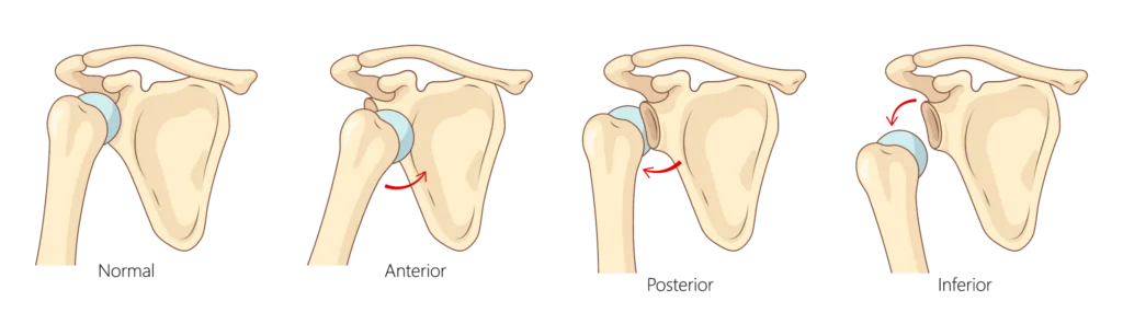 Shoulder instability. 