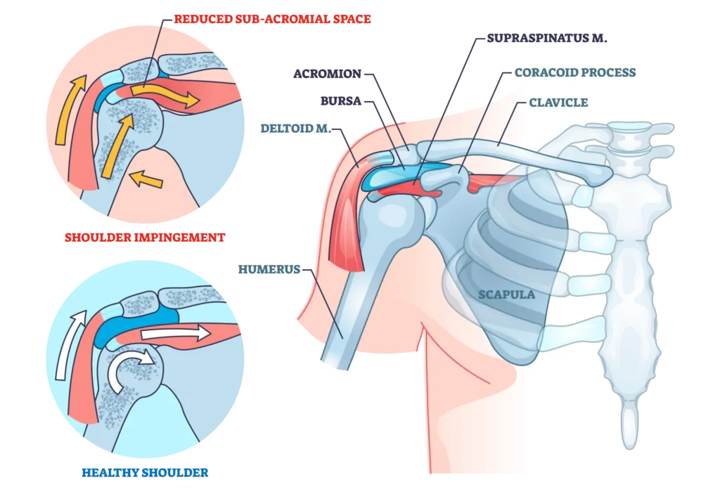 shoulder impingement diagram, comparing a healthy and injured shoulder