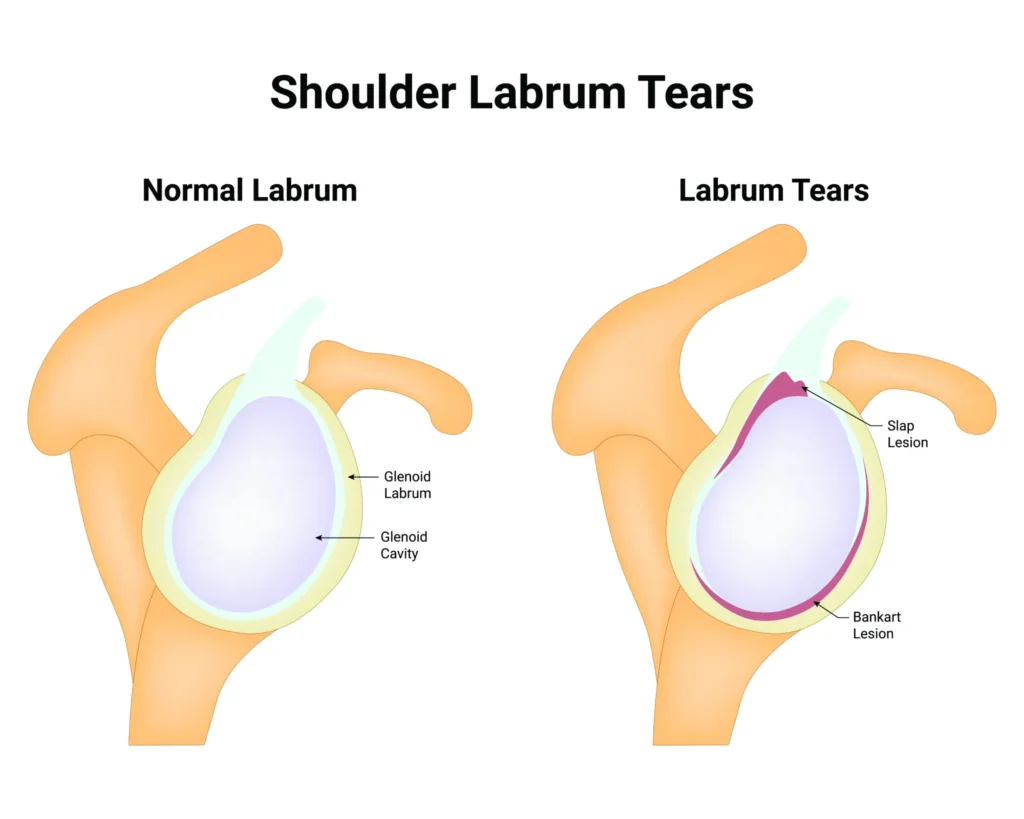 shoulder labrum tears diagram showing the differences between a normal shoulder and a shoulder with a labrum tear.