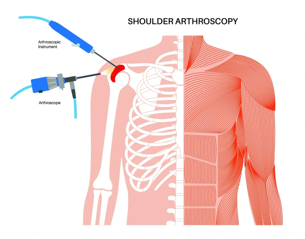 Diagram of shoulder arthroscopy showing the arthroscope and instrument inserted into the joint