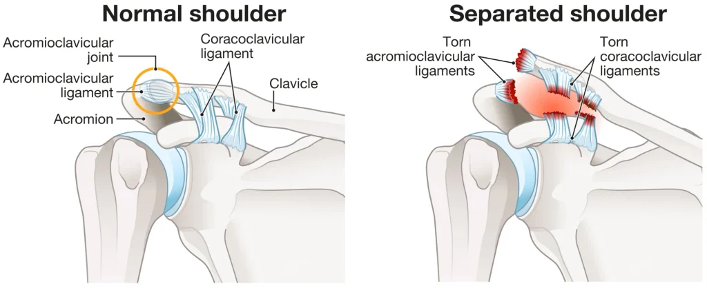 Diagram of AC joint. 